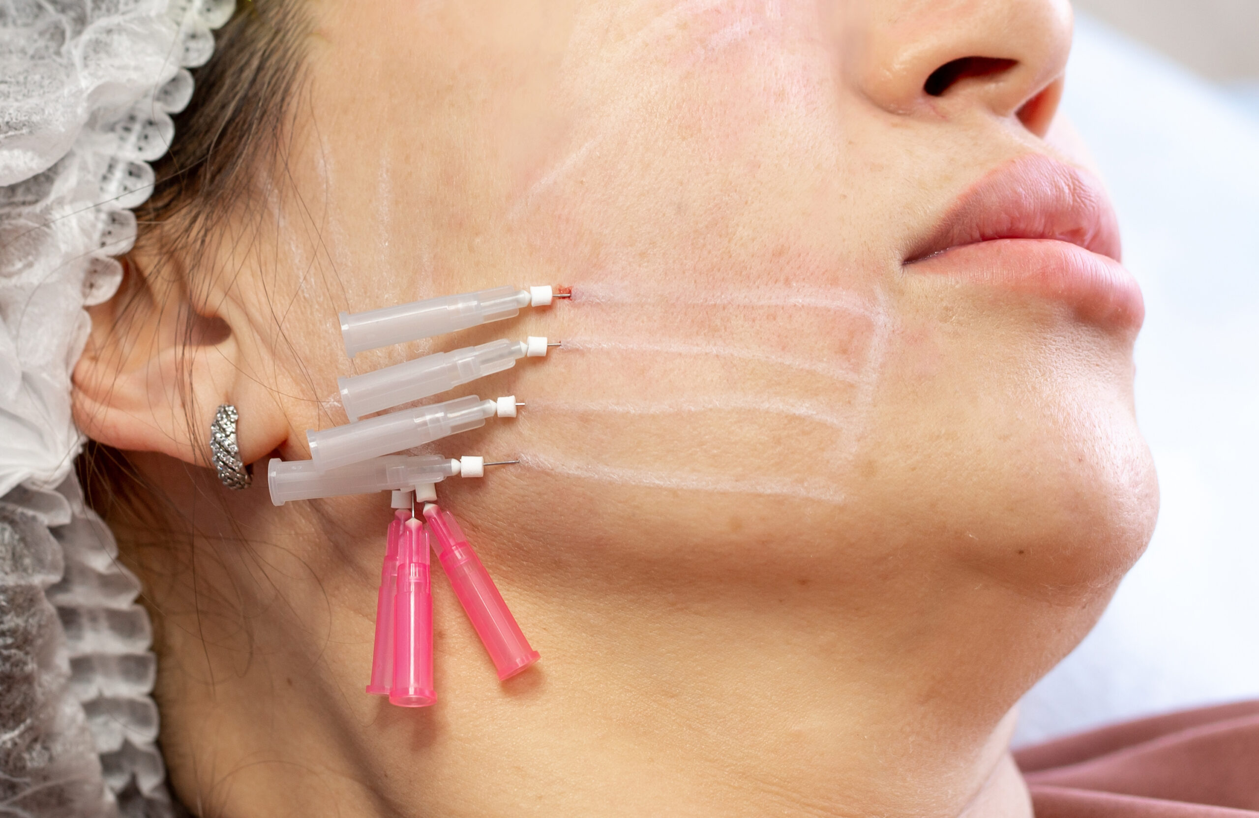 PDO thread aesthetic treatment